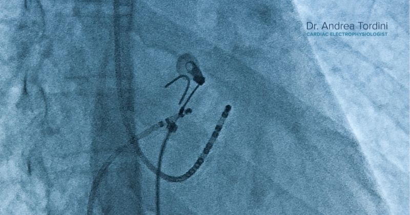 Catheters placed in the chest for a second cardiac ablation procedure for cardiac arrhythmia 