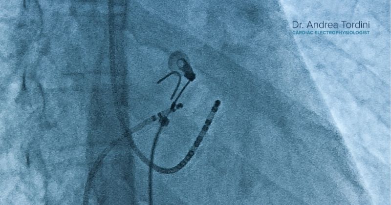 Will I Need a Second Ablation?