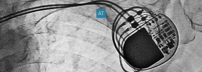 Pacemaker implanted in the chest will last about 10 to 15 years according to Electrophysiologist Dr. Andrea Tordini