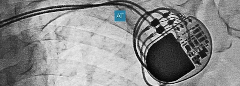 Will I Have to Replace My Pacemaker?