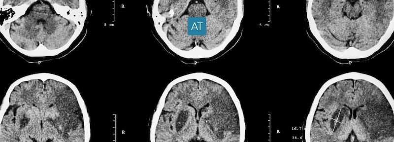 Images showing a stroke in the brain, but what can you do to recognize the signs of a stroke happening?