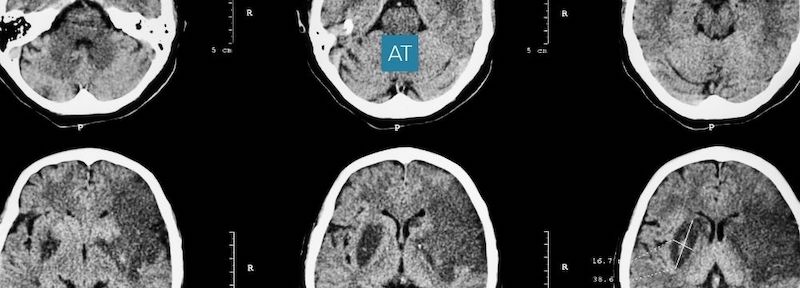 Reminder of Stroke Warning Signs