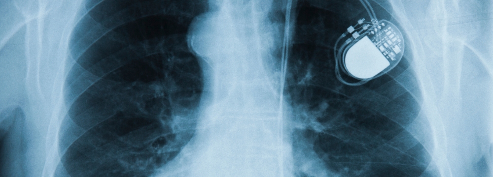 Xray shows a patient with a traditional pacemaker 