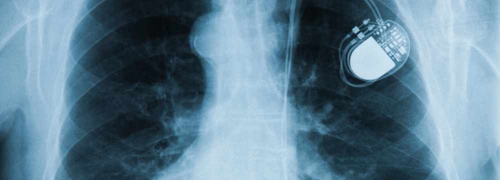 Comparing Traditional Pacemakers to Leadless Pacemakers. Is One Better?