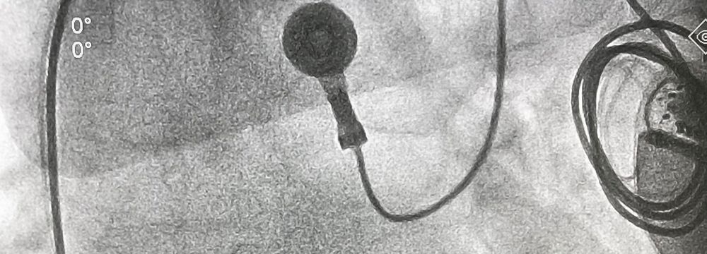 Is Getting Your Pacemaker Replaced a Big Deal?