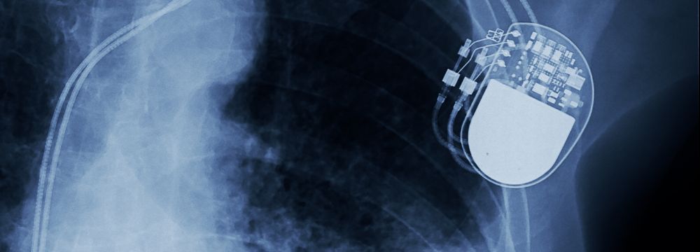 Will You Need a Pacemaker After a TAVR?